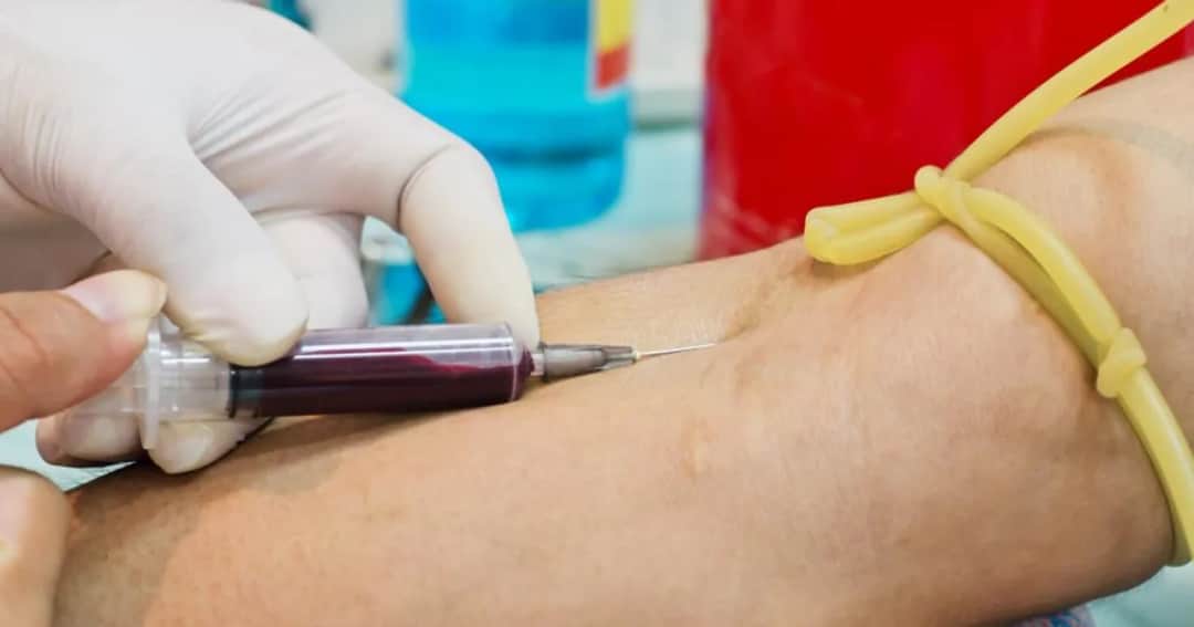 Badanie cholesterolu na czczo czy po jedzeniu – co musisz wiedzieć?